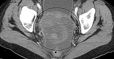 Paesi Con La Più Alta Incidenza Di Cancro Ovarico Nel Mondo